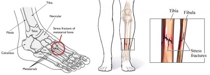 Why is it difficult to walk with a fractured fibula?